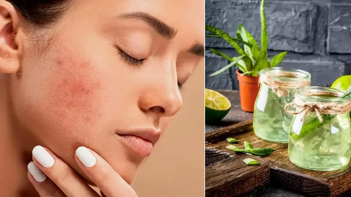 acne treatment 02.10