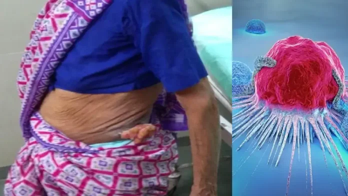 petticoat cancer 10.11