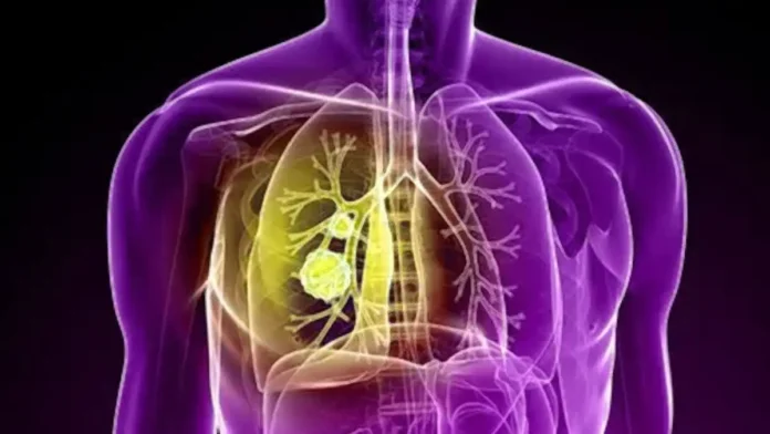 Lung Cancer