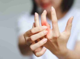 Rheumatoid Arthritis