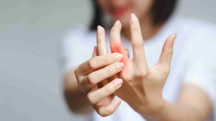 Rheumatoid Arthritis